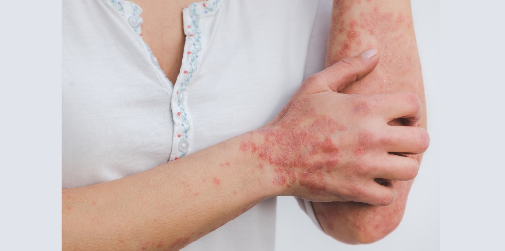 22.08.2023 Фонд «ПОДСОЛНУХ» начинает поддерживать пациентов с псориазом - хроническим иммуноассоциированным заболеванием 